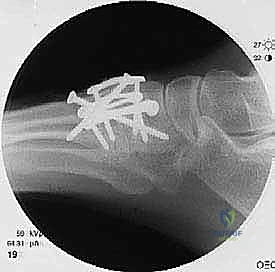 صورة تظهر التثبيت المتقاطع