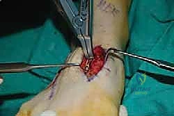 صورة طبية: تثبيت مفصل منتصف القدم: حل دائم لتشوهات القدم المعقدة واستعادة الحركة