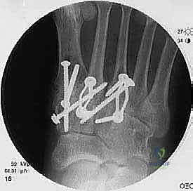 صورة طبية: تثبيت مفصل منتصف القدم: حل دائم لتشوهات القدم المعقدة واستعادة الحركة