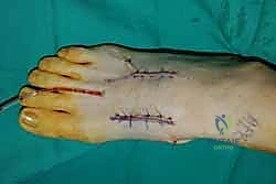 صورة طبية: تثبيت مفصل منتصف القدم: حل دائم لتشوهات القدم المعقدة واستعادة الحركة