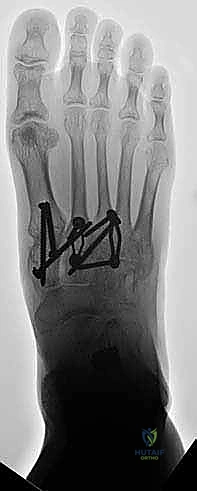 تأكيد قوة التثبيت الميكانيكي