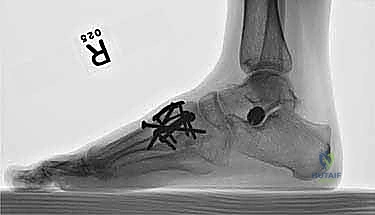 صورة توضيحية لـ تثبيت مفصل منتصف القدم: حل دائم لتشوهات القدم المعقدة واستعادة الحركة