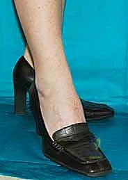 صورة طبية: تثبيت مفصل منتصف القدم: حل دائم لتشوهات القدم المعقدة واستعادة الحركة