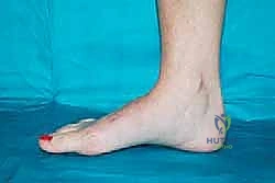 صورة طبية: تثبيت مفصل منتصف القدم: حل دائم لتشوهات القدم المعقدة واستعادة الحركة