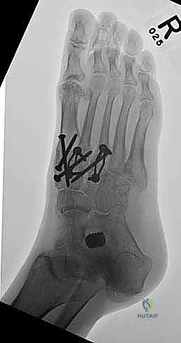 صورة طبية: تثبيت مفصل منتصف القدم: حل دائم لتشوهات القدم المعقدة واستعادة الحركة