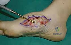 صورة طبية: تثبيت مفصل منتصف القدم: حل دائم لتشوهات القدم المعقدة واستعادة الحركة