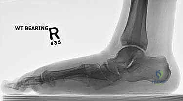 صورة طبية: تثبيت مفصل منتصف القدم: حل دائم لتشوهات القدم المعقدة واستعادة الحركة