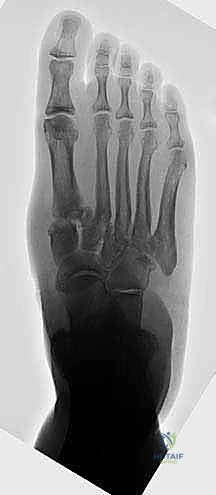 إدخال أسلاك التوجيه المبدئية K-wires