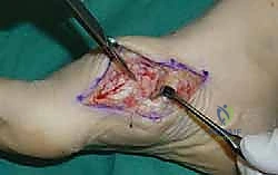 صورة طبية: تثبيت مفصل منتصف القدم: حل دائم لتشوهات القدم المعقدة واستعادة الحركة