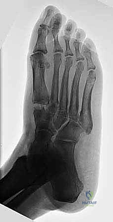 صورة طبية: تثبيت مفصل منتصف القدم: حل دائم لتشوهات القدم المعقدة واستعادة الحركة