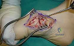 صورة توضيحية لـ تثبيت مفصل منتصف القدم: حل دائم لتشوهات القدم المعقدة واستعادة الحركة