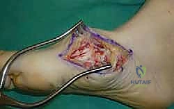 صورة طبية: تثبيت مفصل منتصف القدم: حل دائم لتشوهات القدم المعقدة واستعادة الحركة