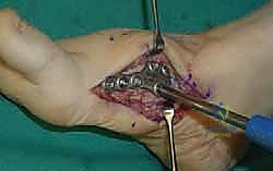 صورة طبية: تثبيت مفصل منتصف القدم: حل دائم لتشوهات القدم المعقدة واستعادة الحركة