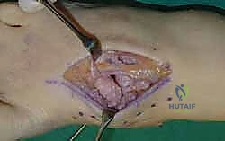 صورة طبية: تثبيت مفصل منتصف القدم: حل دائم لتشوهات القدم المعقدة واستعادة الحركة