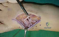 حفر مسارات المسامير بدقة