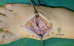 صورة توضيحية لـ تثبيت مفصل منتصف القدم: حل دائم لتشوهات القدم المعقدة واستعادة الحركة