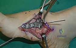 حفر مسار لمسمار عبر المفاصل