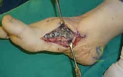 تجهيز مسمار مجوف Cannulated Screw