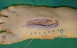 صورة طبية: تثبيت مفصل منتصف القدم: حل دائم لتشوهات القدم المعقدة واستعادة الحركة