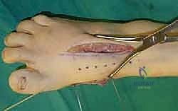 صورة طبية: تثبيت مفصل منتصف القدم: حل دائم لتشوهات القدم المعقدة واستعادة الحركة