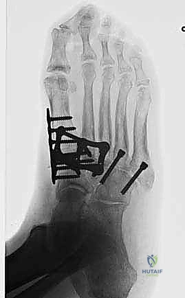 صورة طبية: تثبيت مفصل منتصف القدم: حل دائم لتشوهات القدم المعقدة واستعادة الحركة