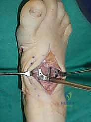 صورة طبية: تثبيت مفصل منتصف القدم: حل دائم لتشوهات القدم المعقدة واستعادة الحركة