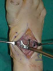 صورة طبية: تثبيت مفصل منتصف القدم: حل دائم لتشوهات القدم المعقدة واستعادة الحركة