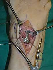 صورة طبية: تثبيت مفصل منتصف القدم: حل دائم لتشوهات القدم المعقدة واستعادة الحركة