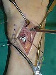 صورة طبية: تثبيت مفصل منتصف القدم: حل دائم لتشوهات القدم المعقدة واستعادة الحركة