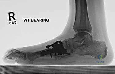 صورة طبية: تثبيت مفصل منتصف القدم: حل دائم لتشوهات القدم المعقدة واستعادة الحركة