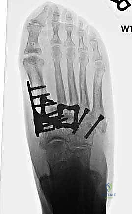 صورة طبية: تثبيت مفصل منتصف القدم: حل دائم لتشوهات القدم المعقدة واستعادة الحركة