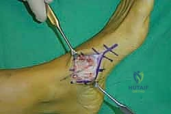 صورة طبية: تثبيت مفصل منتصف القدم: حل دائم لتشوهات القدم المعقدة واستعادة الحركة