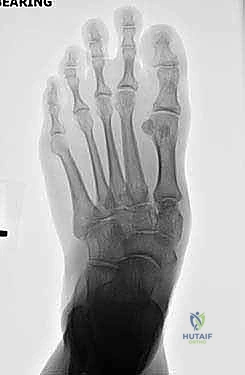 صورة طبية: تثبيت مفصل منتصف القدم: حل دائم لتشوهات القدم المعقدة واستعادة الحركة