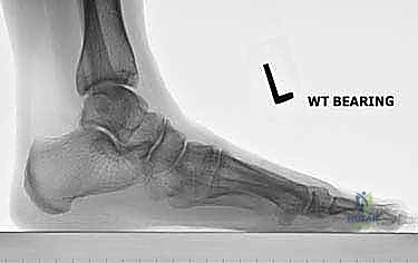 إحكام ربط المسمار لضغط العظام معاً