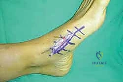صورة طبية: تثبيت مفصل منتصف القدم: حل دائم لتشوهات القدم المعقدة واستعادة الحركة