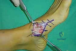 صورة طبية: تثبيت مفصل منتصف القدم: حل دائم لتشوهات القدم المعقدة واستعادة الحركة