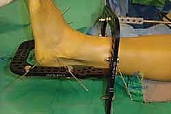 صورة طبية: تثبيت مفصل منتصف القدم: حل دائم لتشوهات القدم المعقدة واستعادة الحركة