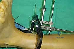 إضافة مسامير الضغط Compression Screws