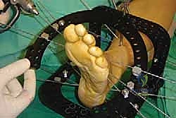 تجهيز الشرائح المعدنية للتثبيت