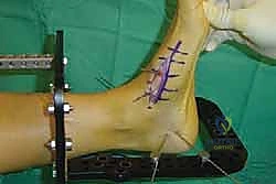 استخدام الأدوات الدقيقة لإزالة الغضروف