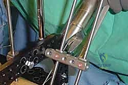 صورة توضيحية لـ تثبيت مفصل منتصف القدم: حل دائم لتشوهات القدم المعقدة واستعادة الحركة