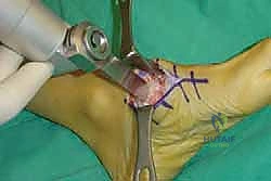 صورة طبية: تثبيت مفصل منتصف القدم: حل دائم لتشوهات القدم المعقدة واستعادة الحركة