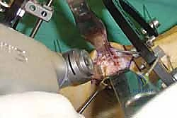 صورة طبية: تثبيت مفصل منتصف القدم: حل دائم لتشوهات القدم المعقدة واستعادة الحركة