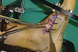 صورة طبية: تثبيت مفصل منتصف القدم: حل دائم لتشوهات القدم المعقدة واستعادة الحركة