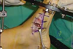 صورة طبية: تثبيت مفصل منتصف القدم: حل دائم لتشوهات القدم المعقدة واستعادة الحركة