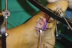 التخطيط لزوايا التثبيت