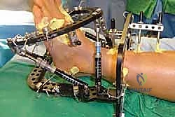 صورة طبية: تثبيت مفصل منتصف القدم: حل دائم لتشوهات القدم المعقدة واستعادة الحركة