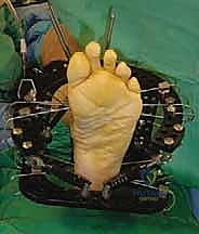 صورة توضيحية لـ تثبيت مفصل منتصف القدم: حل دائم لتشوهات القدم المعقدة واستعادة الحركة