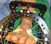 صورة طبية: تثبيت مفصل منتصف القدم: حل دائم لتشوهات القدم المعقدة واستعادة الحركة