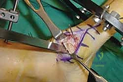 صورة طبية: تثبيت مفصل منتصف القدم: حل دائم لتشوهات القدم المعقدة واستعادة الحركة